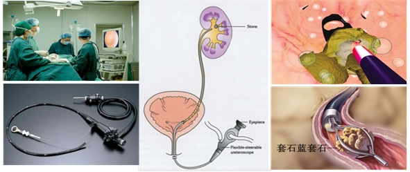 【专家解析】肾结石的症状有哪些？(图6)