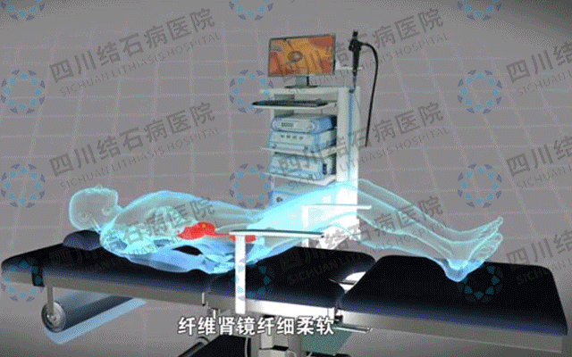 治疗肾结石需要多少钱？(图5)