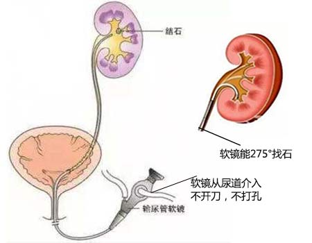 患者疑问：肾积水严重吗?(图10)