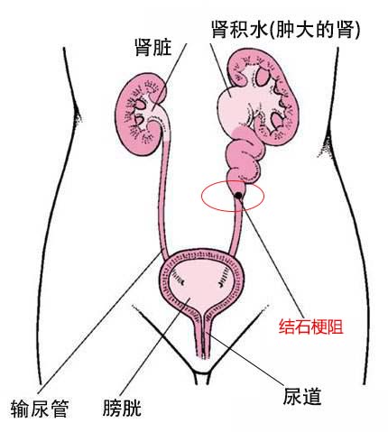 引起肾结石的4大因素，看看你是如何中招的(图7)