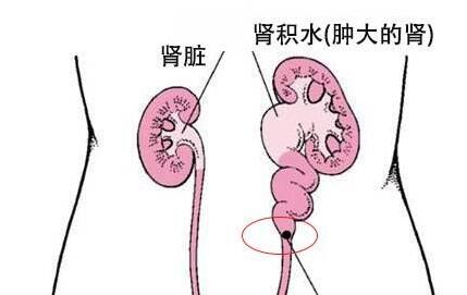 肾结石有哪些症状？该怎么处理？(图5)