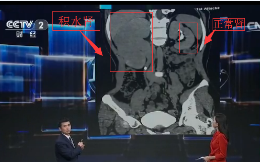患者疑问：肾积水严重吗?(图1)