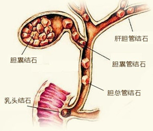 疑问？什么是胆管结石？(图1)