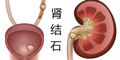 肾结石体外碎石多少钱(图1)