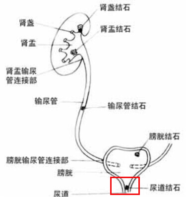 尿结石的症状及危害你了解多少？(图5)