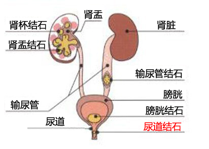 专家解析：尿道结石较好的治疗方法(图1)