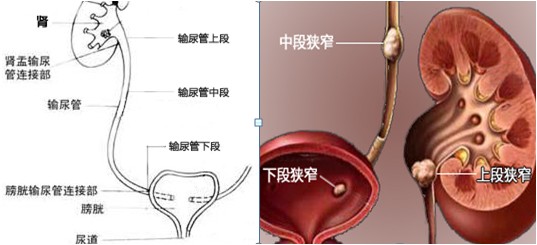 治疗尿结石哪家医院好(图1)