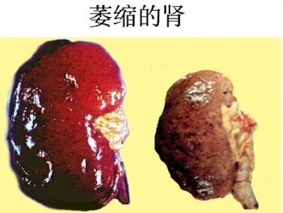 四川结石病医院详解：左肾积水(图2)