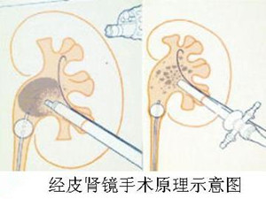 专家在线解答：肾结石该怎么办？(图2)