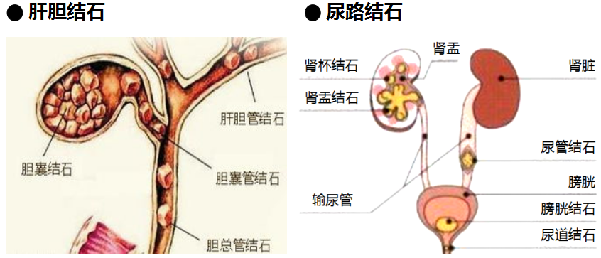 用这个方法打结石，安全、快速、高效！(图1)