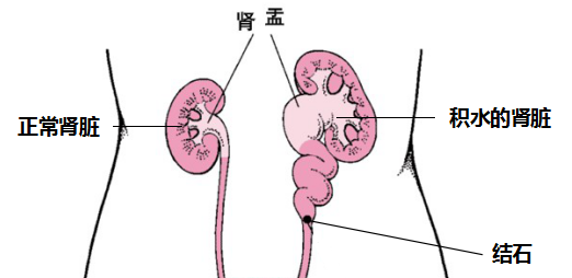 怎么轻松解决输尿管结石伴肾积水？(图2)