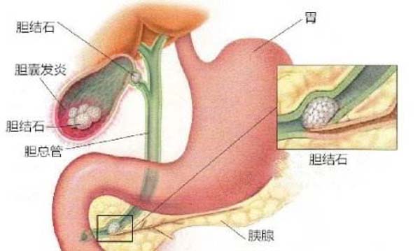 胆结石吃东西就能排出来？还要医院干啥？(图2)