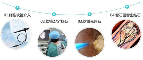 输尿管结石要这样治疗才正确！(图5)